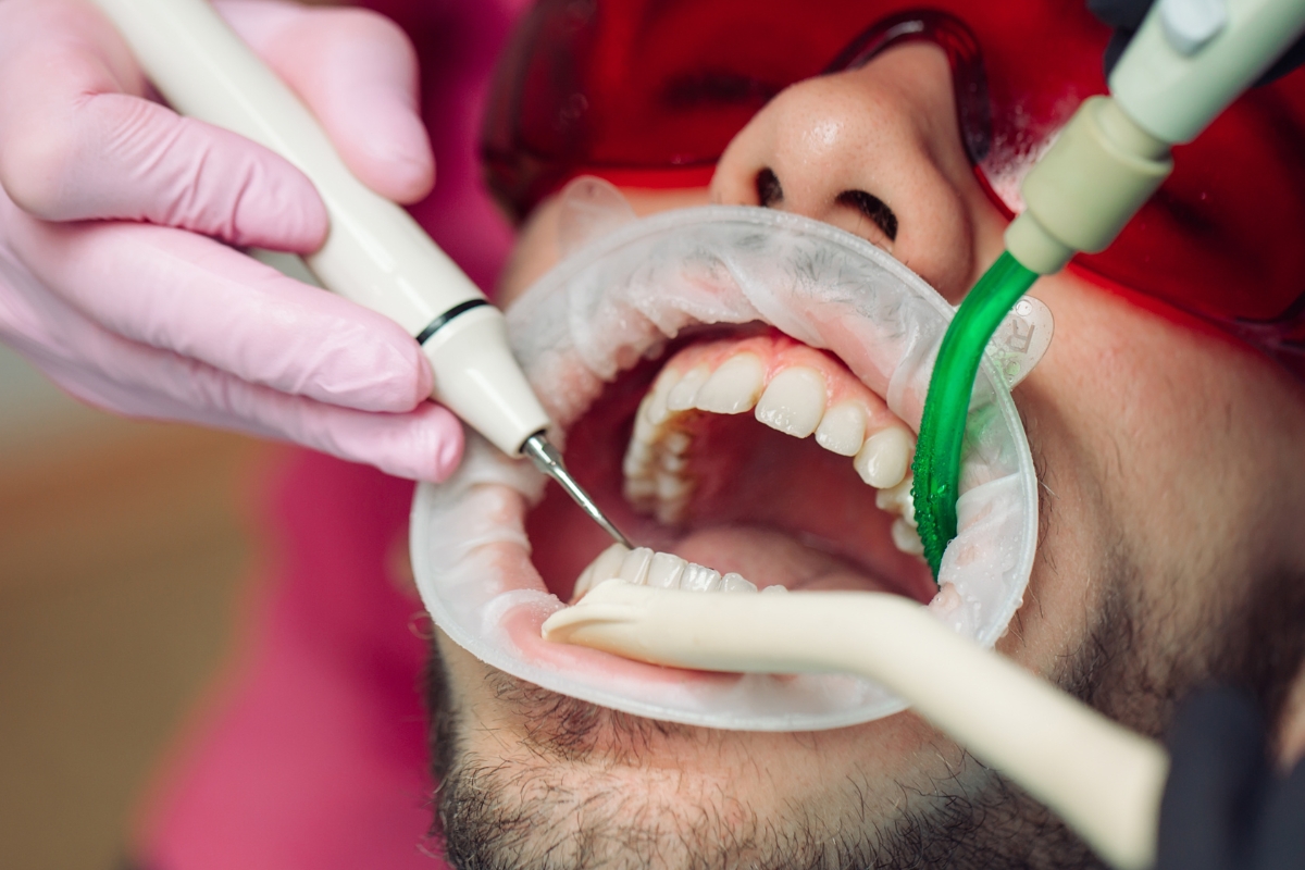 Teeth Cleaning and Polishing in Anand