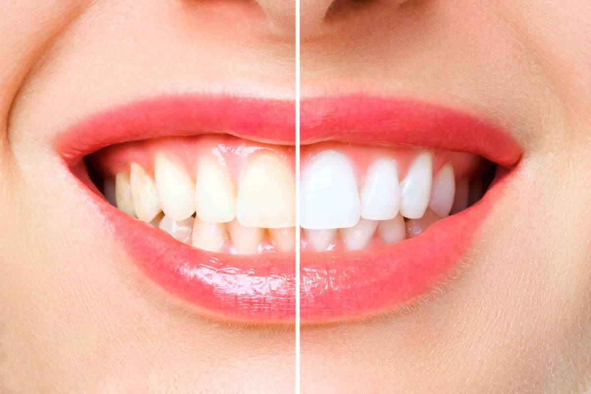 Teeth Whitening in Anand