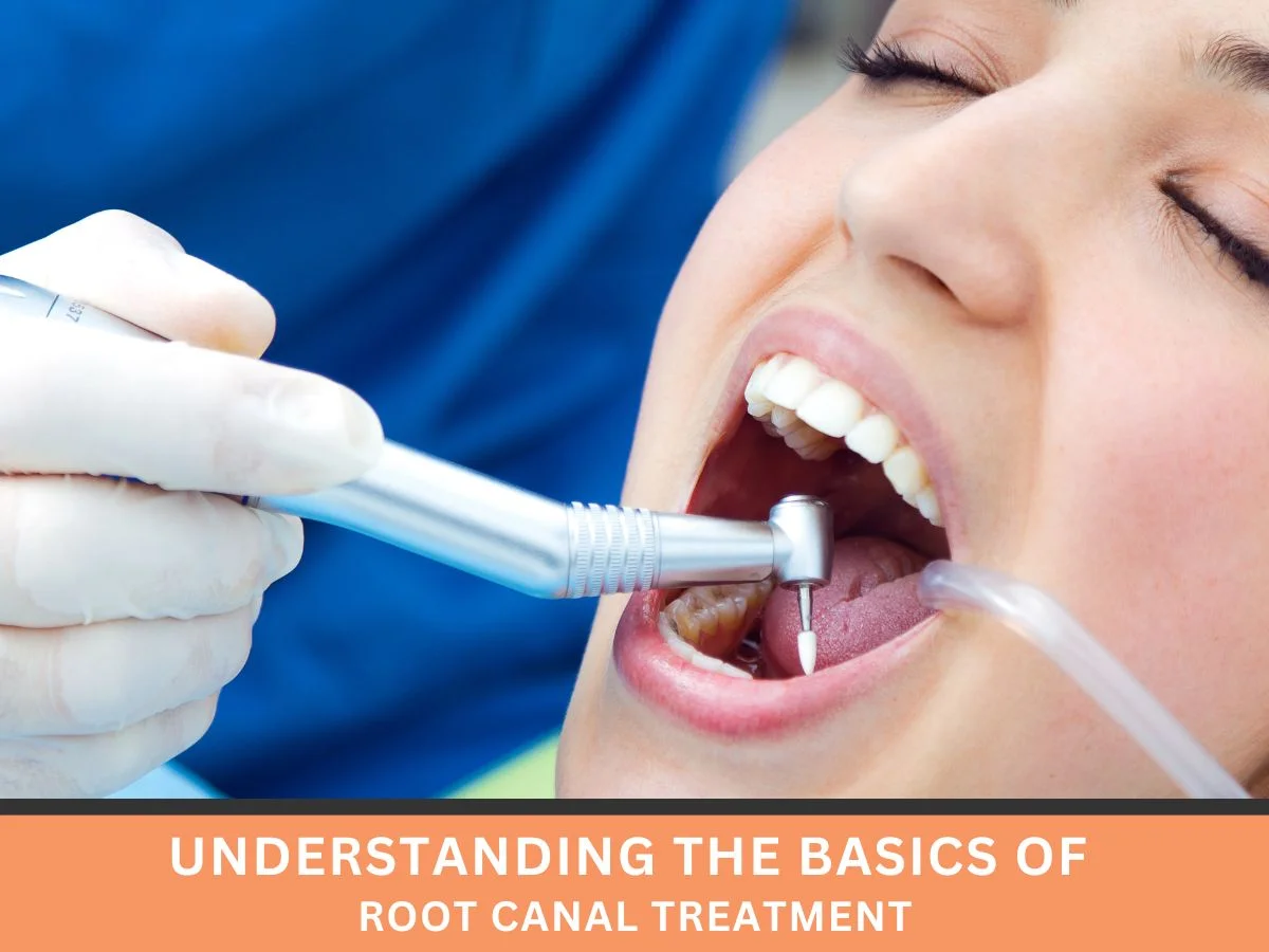 Understanding the Basics of Root Canal Treatment