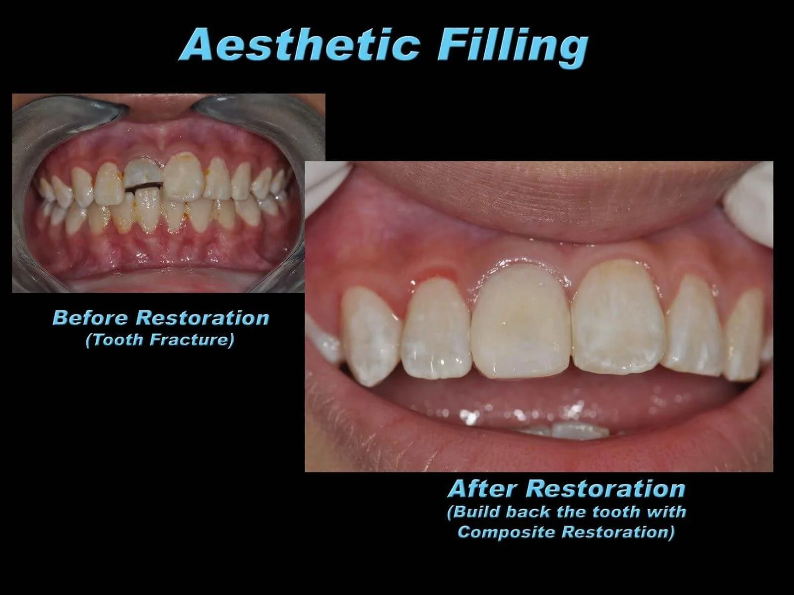 Aesthetic Painless Dental Filling