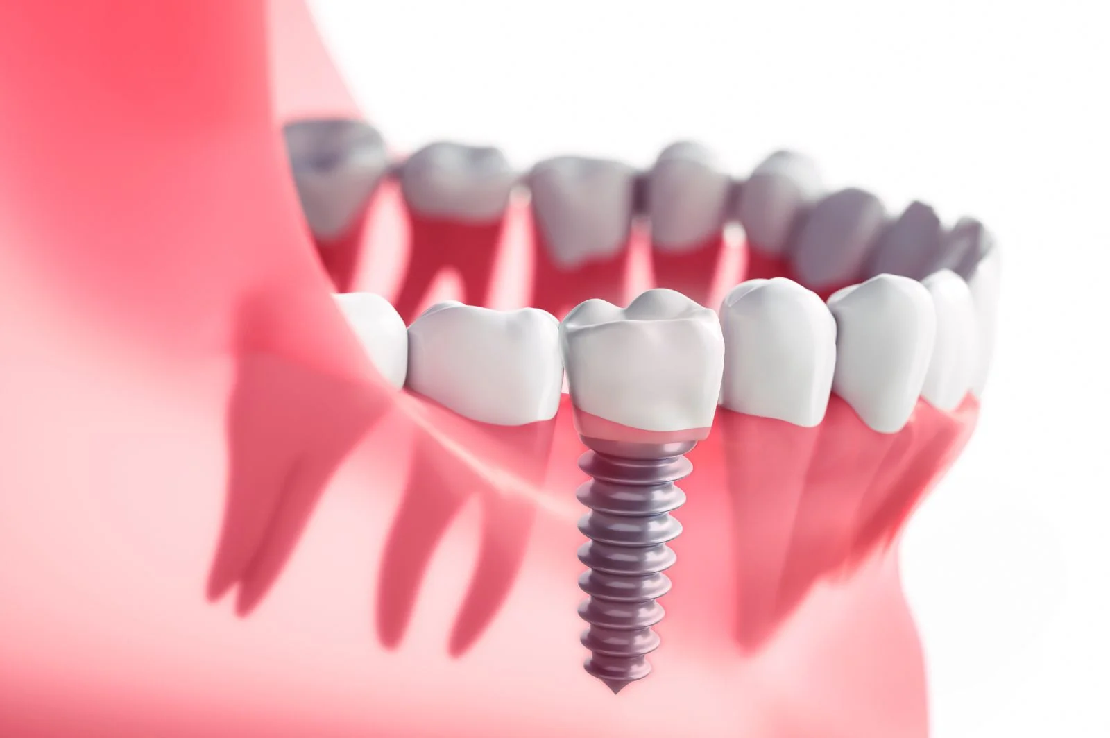 Dr_Gandhi_Dental_Clinic_Treatments_Dental_Implants_Screw_And_Teeth