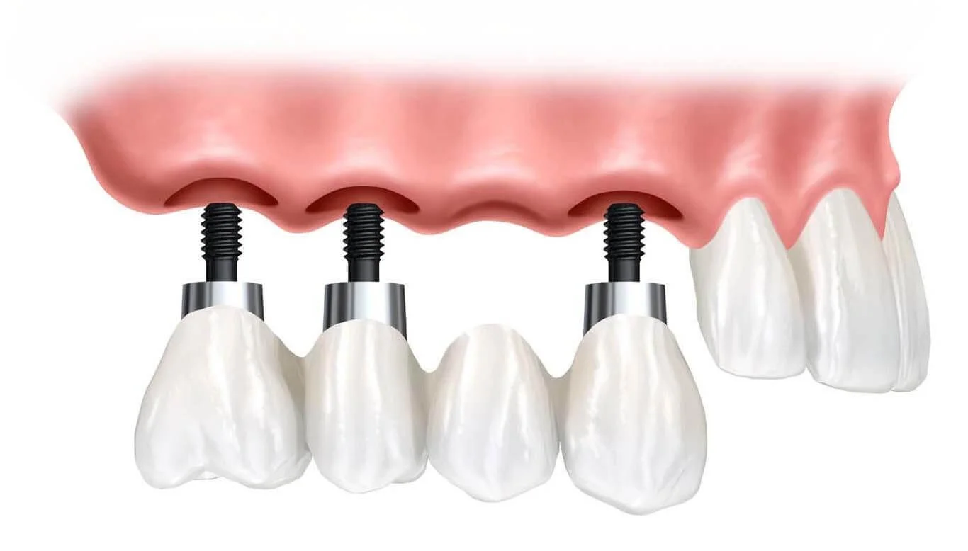 Dr_Gandhi_Dental_Clinic_Treatment_Dental_Implants_Of_Dental_Implant_Procedure
