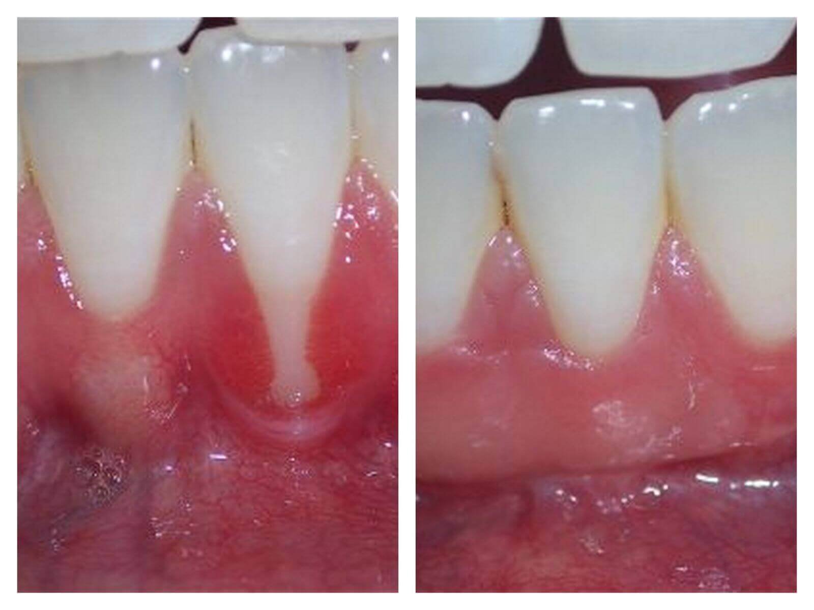 Dr_Gandhi_Dental_Clinic_Treatment_Page_Gum_and-Oral-Surgeries-1_image_At_Gum_Surgeries.
