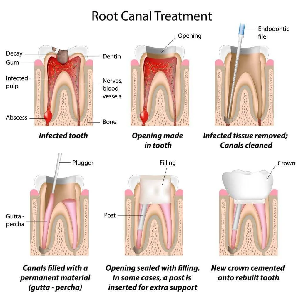 Dr_Gandhi_Dental_Clinic_Home_Page_Treatment_What_Is _Root_Canal_At_Root_Canal_Treatment