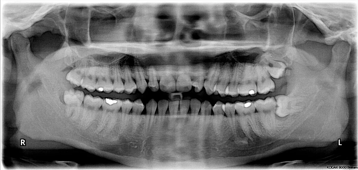 Dr_Gandhi_Dental_Clinic_Treatment_Wisdom_Teeth_At_Third_Molar_Surgery_1